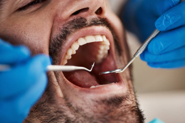 Best Emergency Dental Care for Broken or Chipped Teeth in Morgantown, PA